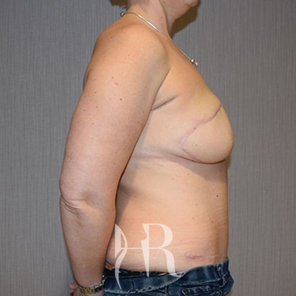 HR Plastic Surgery - Breast Reconstruction patient after 5